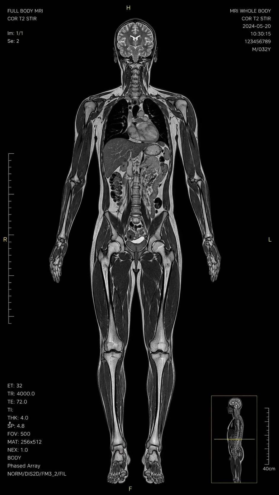 Full Body MRI scan result